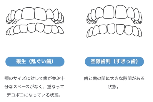 インビザライン Go矯正｜インビザライン・ジャパン【公式】のコピー.jpg