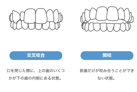 インビザライン Go矯正｜インビザライン・ジャパン【公式】.jpg